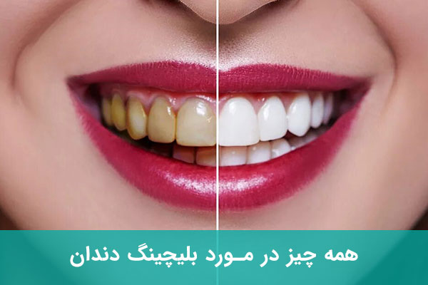 انواع روش بلیچینگ