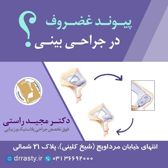 غضروف بینی: طبیعی یا مصنوعی | انتخاب بهترین نوع برای جراحی