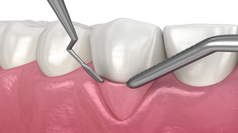 جراحی پیوند لثه برای کاشت ایمپلنت دندان