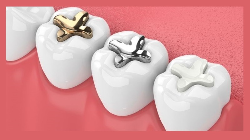 پر کردن دندان‌ها بدون فلز