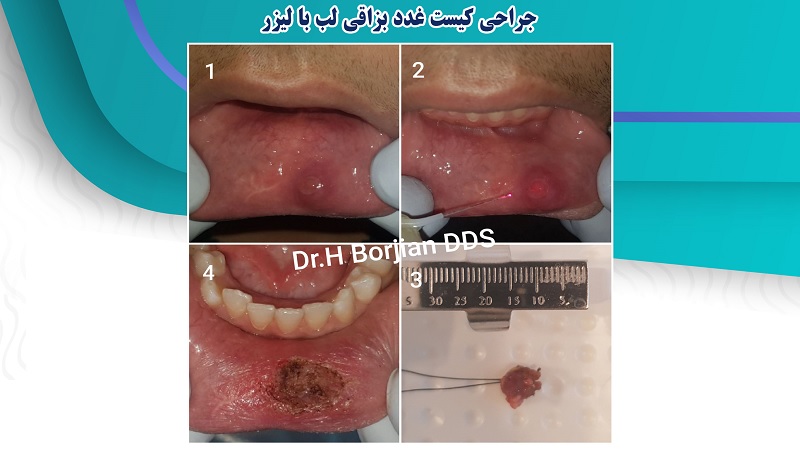 نمونه جراحی کیست غدد بزاقی لب با لیزر
