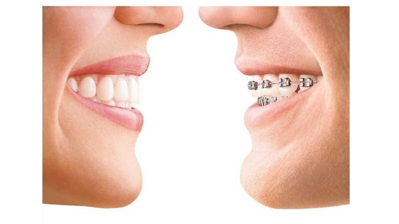 معرفی ابزارهای ارتودنسی ثابت دندان