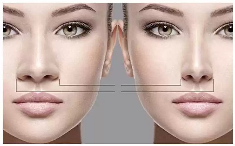 انواع جراحی بینی در اصفهان | کدام روش برای شما مناسب است؟