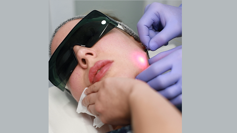 انجام همزمان اندولیفت با PRP یا مزوتراپی