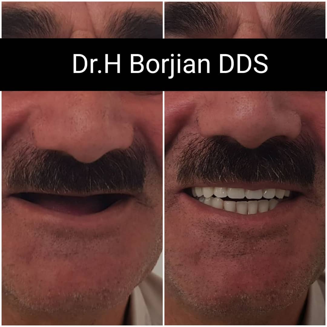 پروتز کامل فکین (دندان مصنوعی دو فک)