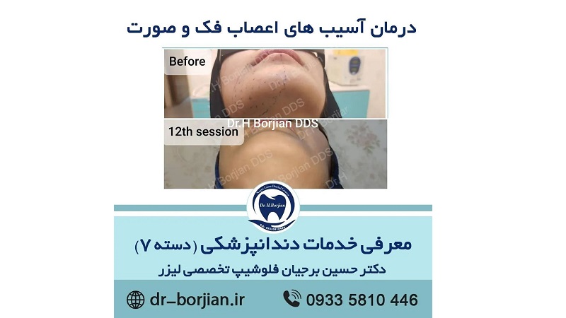 درمان آسیب های اعصاب فک و صورت