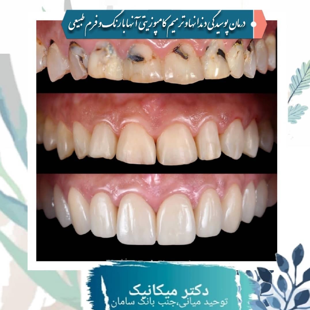 ترمیم زیبایی کامپوزیت دندان