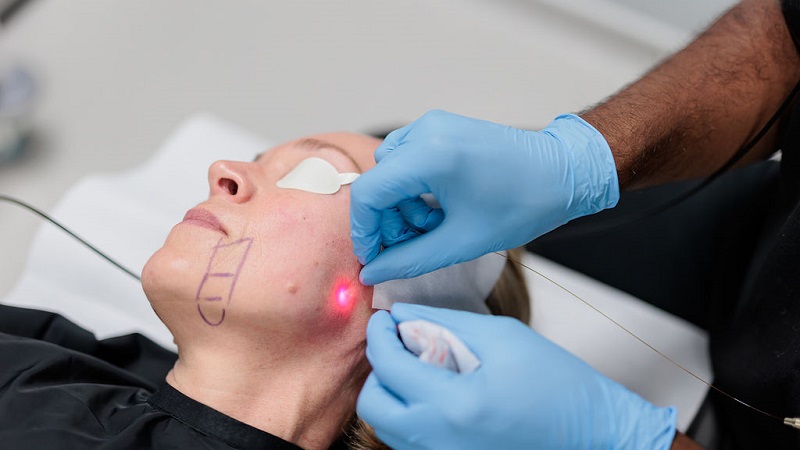 نکات کلیدی قبل از انجام اندولیفت