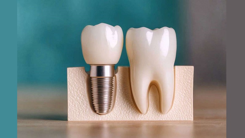 مراقبت از ایمپلنت برای بالاترین طول عمر و زیبایی