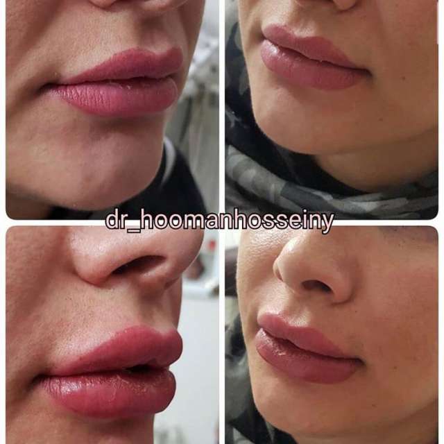 میزان ماندگاری تزریق ژل لب چقدر است ؟