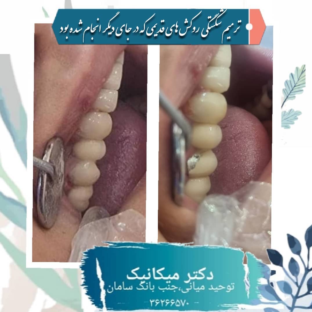 ترمیم شکستگی روکش های قدیمی