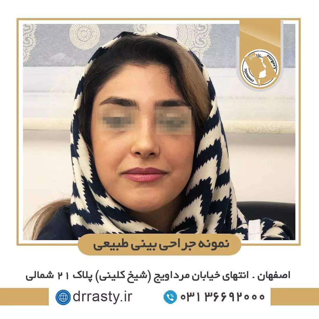 نمونه ای از یک بینی طبیعی