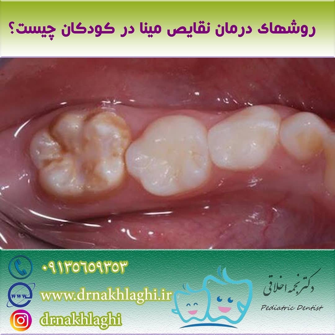 درمان نواقص مینای دندان در کودکان