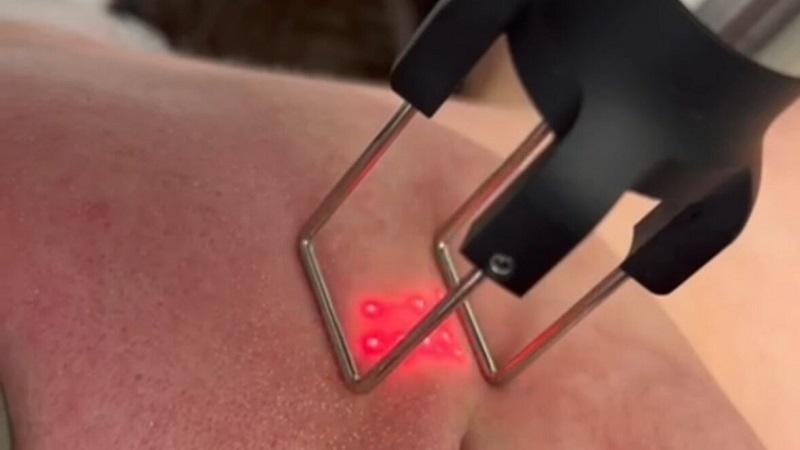 مقایسه واقعی لیزر فرکشنال CO₂ با Fraxel Erbium برای جای جوش