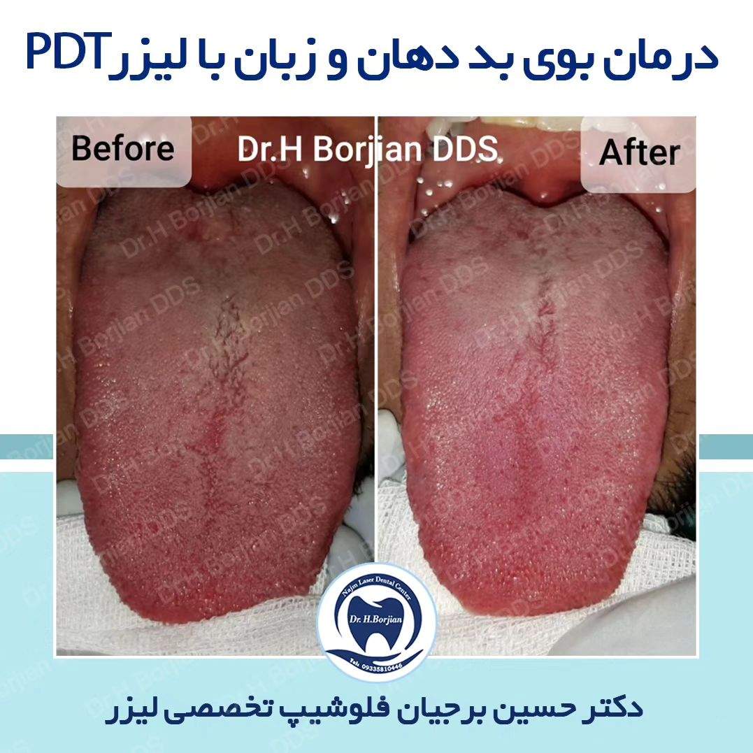 درمان بوی بد دهان و زبان با استفاده از لیزر