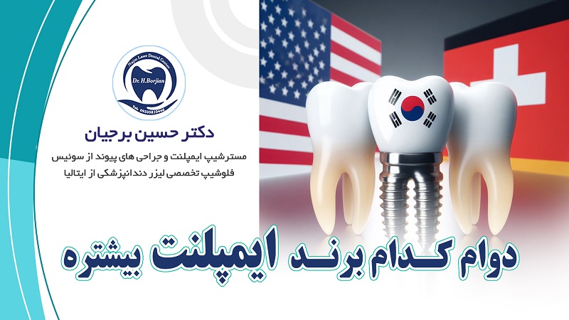 دوام کدام برند ایمپلنت دندان بیشتر است؟