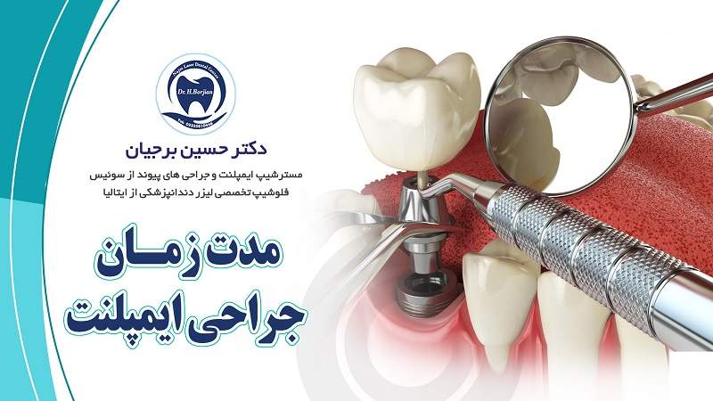 مدت زمان جراحی ایمپلنت چقدر است؟