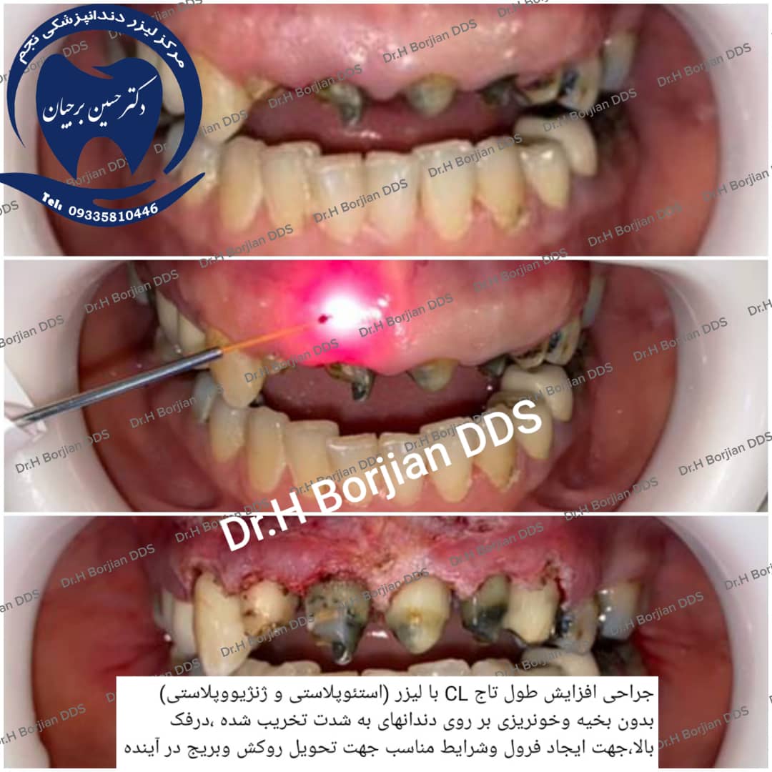 جراحی افزایش طول تاج CL با لیزر