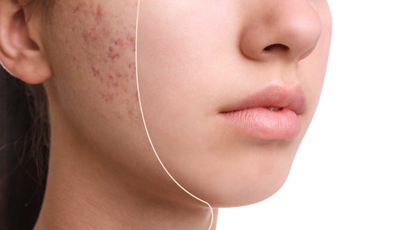 علل ظاهر شدن لک بعد از لیزر جای جوش و راه‌های پیشگیری ساده