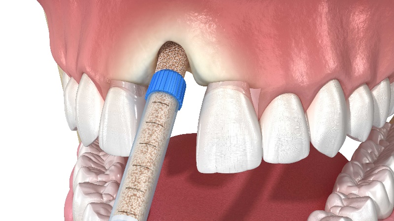 جراحی پیوند استخوان در ایمپلنت دندان