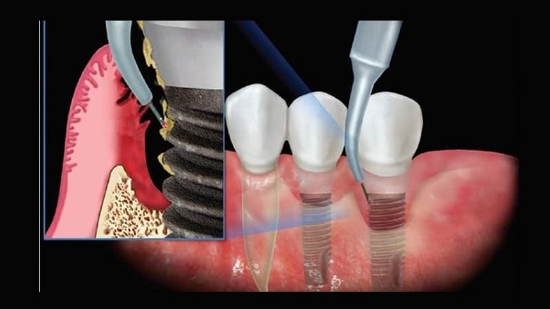 نتایج بلندمدت درمان پری‌ایمپلنتایتیس با لیزر