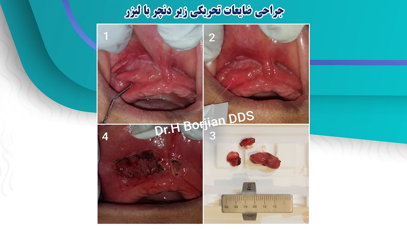 جراحی ضایعات تحریکی زیر دنچر با لیزر