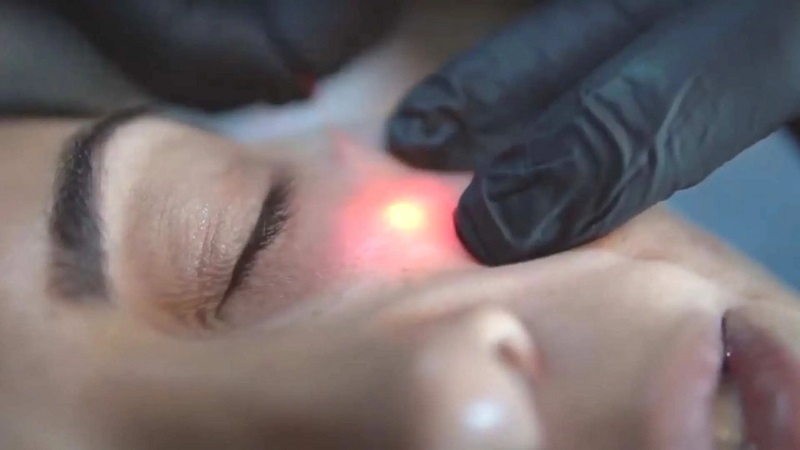 بهترین مرکز لیزر اندولیفت اصفهان کجاست؟