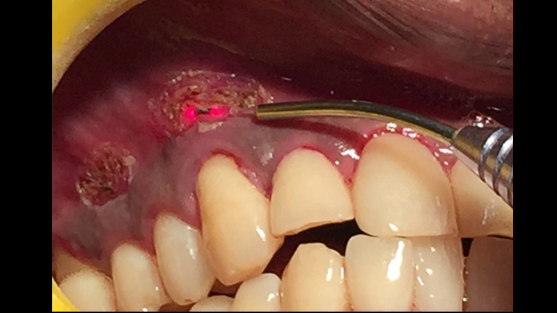 نوآوری در دارورسانی و درمان موضعی در دهان با لیزر