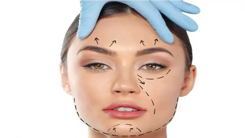 مراحل انجام لیفت با نخ