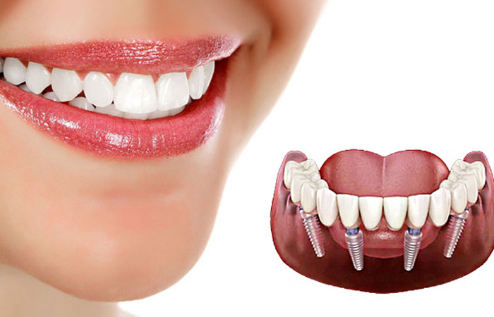 کاشت ایمپلنت دندان در اصفهان | مراحل، مزایا و هزینه‌ها