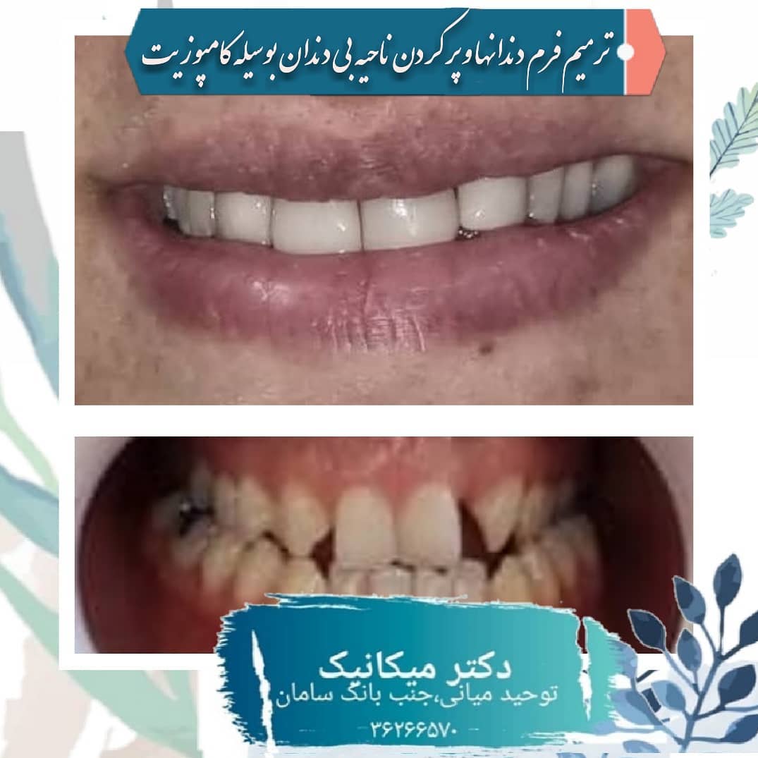 ترمیم فرم دندانها و پر کردن ناحیه بی دندان با کامپوزیت