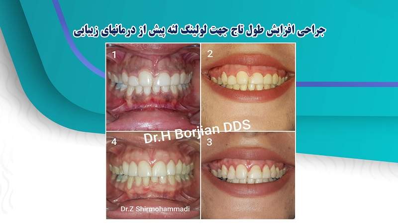 جراحی افزایش طول تاج جهت لولینگ لثه پیش از درمانهای زیبایی