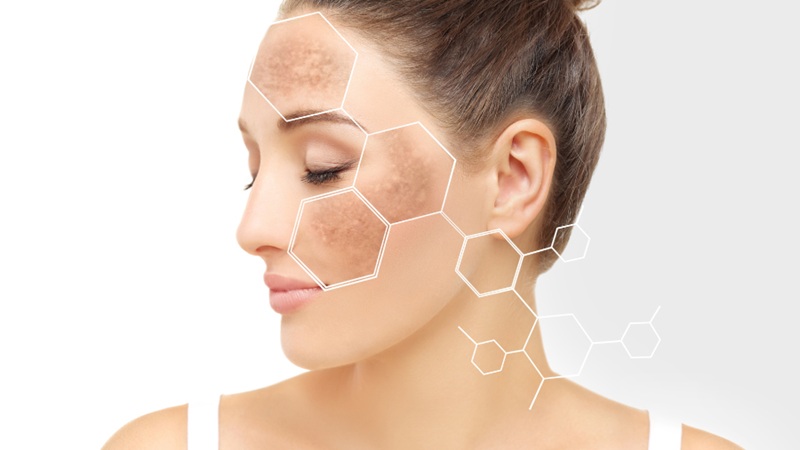 مزوژل برای درمان لک های پوستی