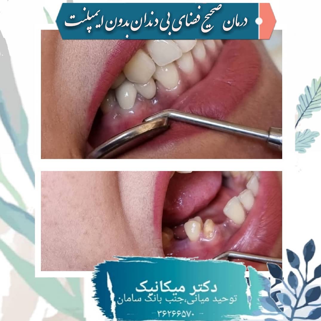 درمان صحیح فضای بی دندان بدون ایمپلنت