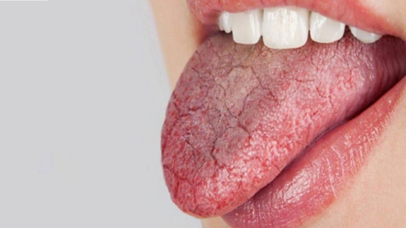 سندرم سوزش زبان و دهان