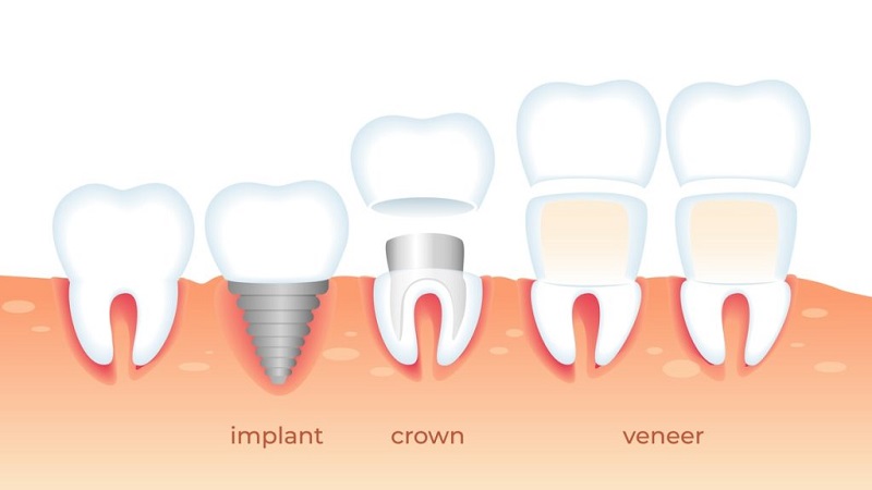 مقایسه ایمپلنت دندان با روکش دندان