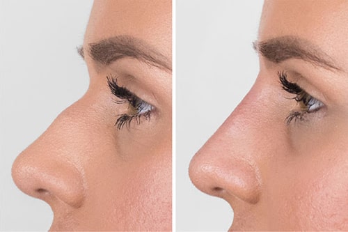 مدلینگ بینی باژل