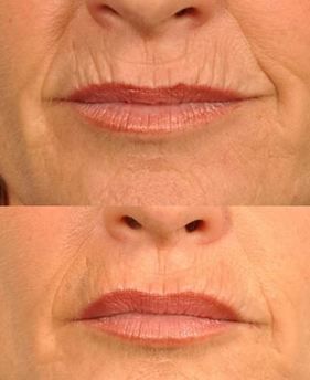 بوتاکس پشت لب