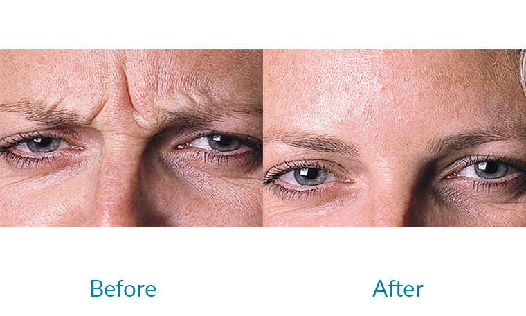 ژل خط اخم رووفیل اولترا