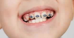 ارتودنسی پیشگیرانه کودکان و نوجوانان