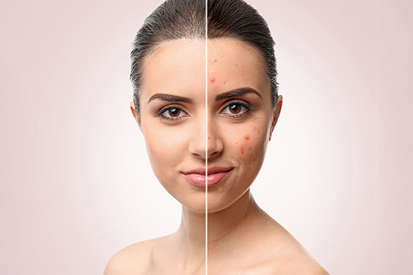 لیزر هانی کومب