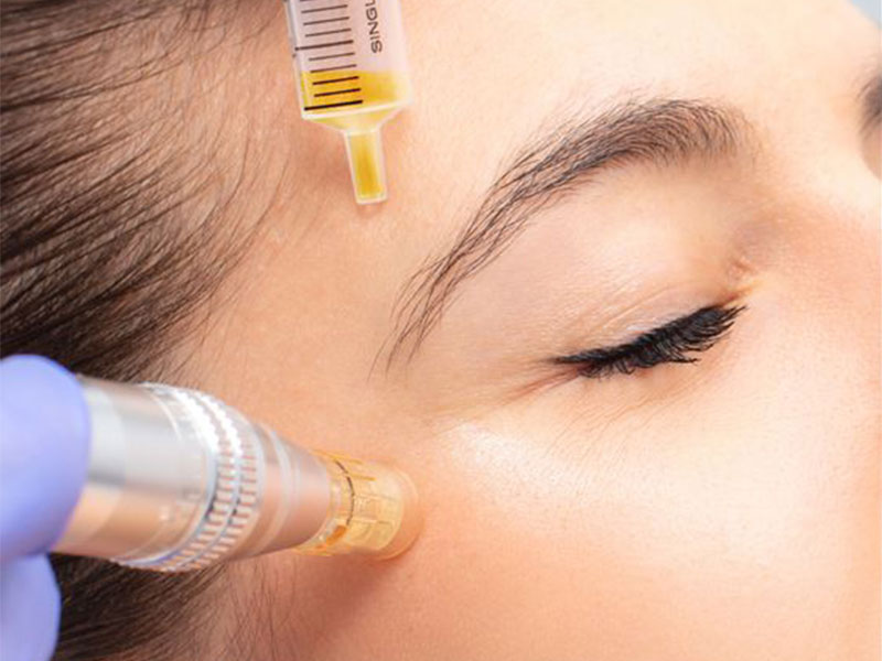 مزونیدلینگ