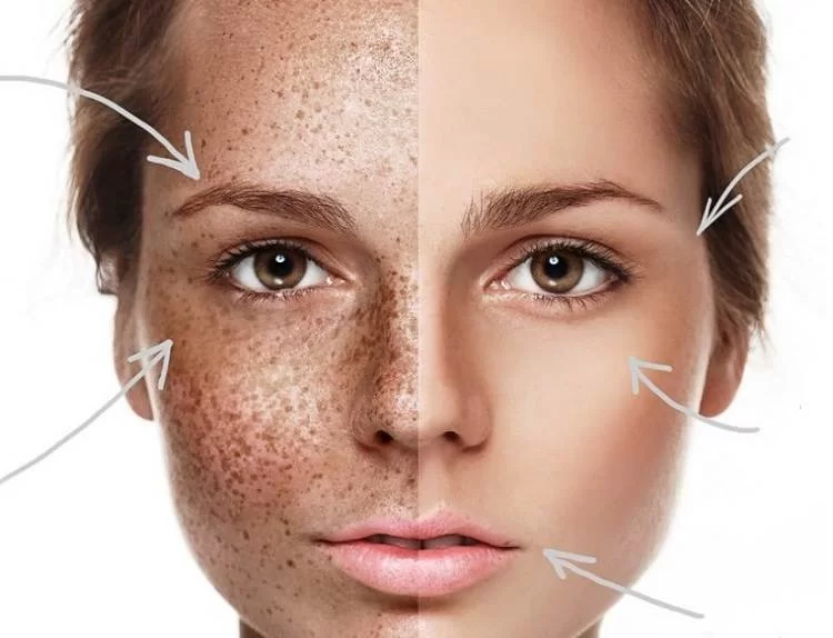 لیزر لک و کک مک