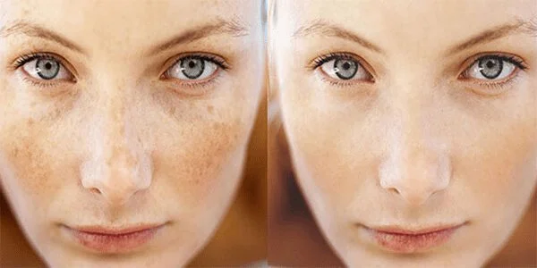 میکرو پیلینگ